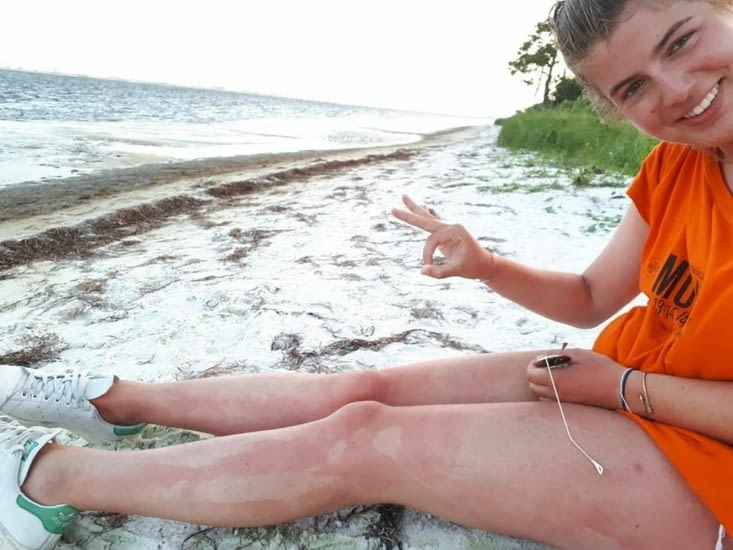 De l'incapacité de se crèmer correctement - et en subir toutes les conséquences